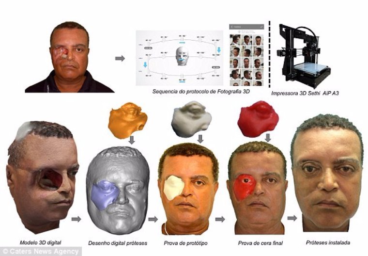 Бразильцу вернули лицо с помощью 3D-принтера