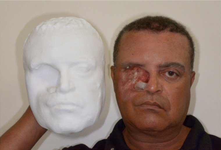 Бразильцу вернули лицо с помощью 3D-принтера