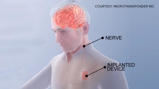 «Мозговой кардиостимулятор» может помочь пациентам быстрее оправиться от инсульта